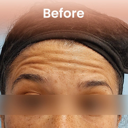 Before Botox in Delhi