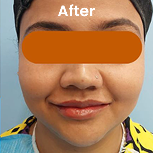 Buccal fat removal after