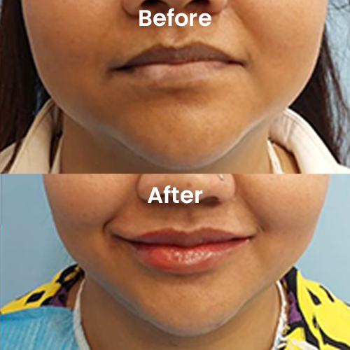 Buccal fat removal before after