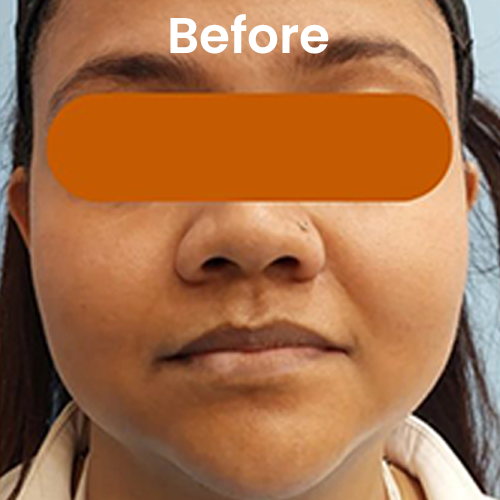 Buccal fat removal before