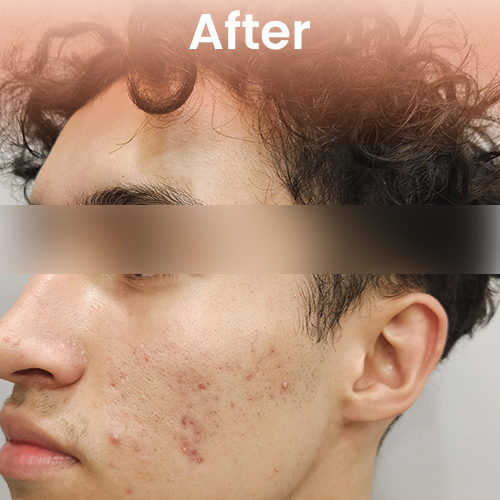 cool jet plasma treatment after