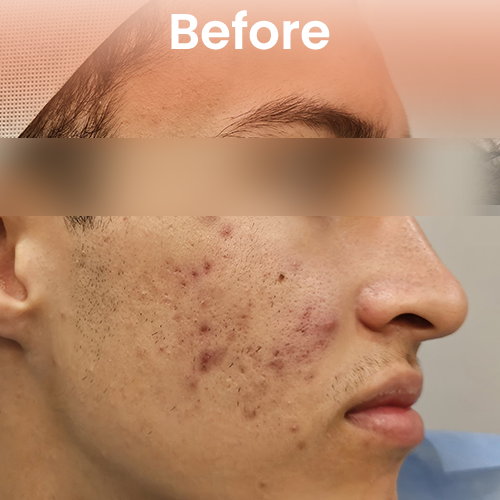 Before cool jet plasma treatment