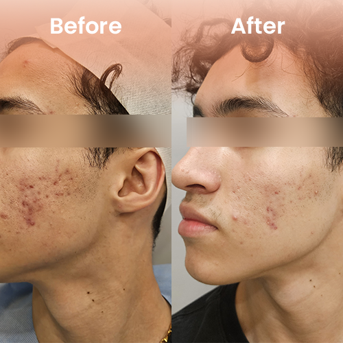 Cool jet plasma skin treatment before and after – tighter and clearer skin