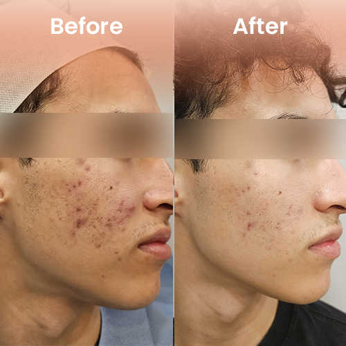 cool jet plasma treatment before and after