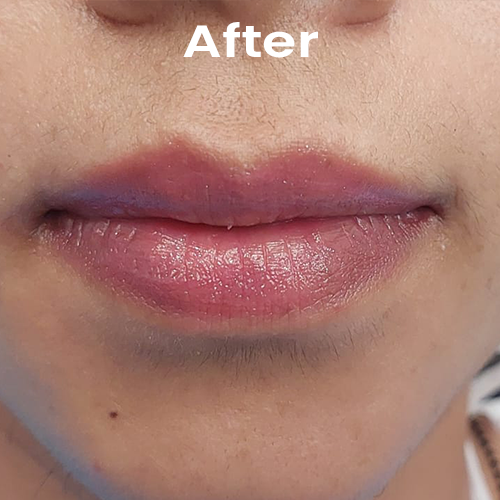 After Dark Lips treatment