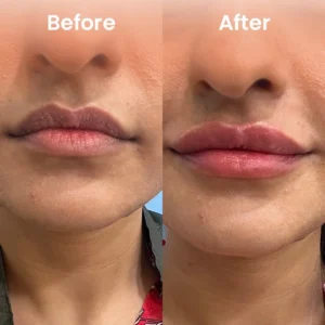 Before and after dark lip treatment – improved lip color and texture