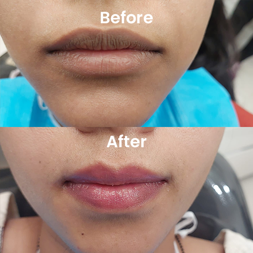 Dark Lips treatment before after