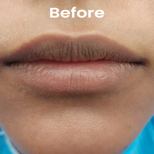 Before Dark Lips treatment