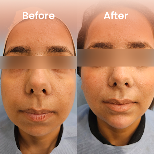 Dermal filler treatment