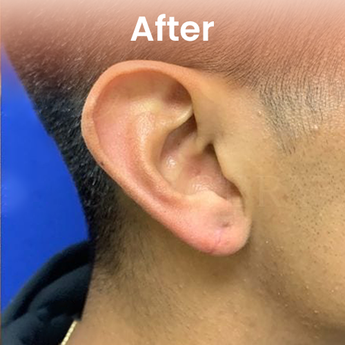 Male earlobe repair after