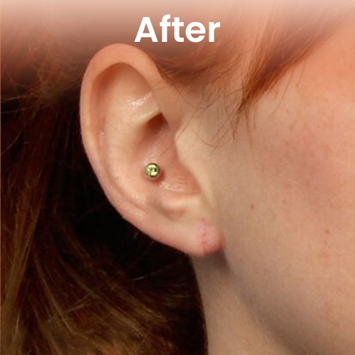 Female earlobe repair after
