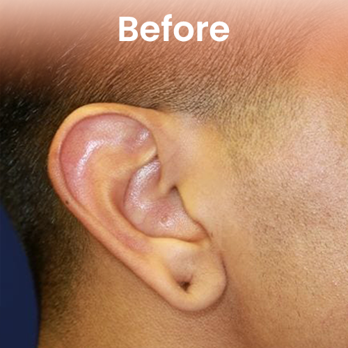 Male earlobe repair before