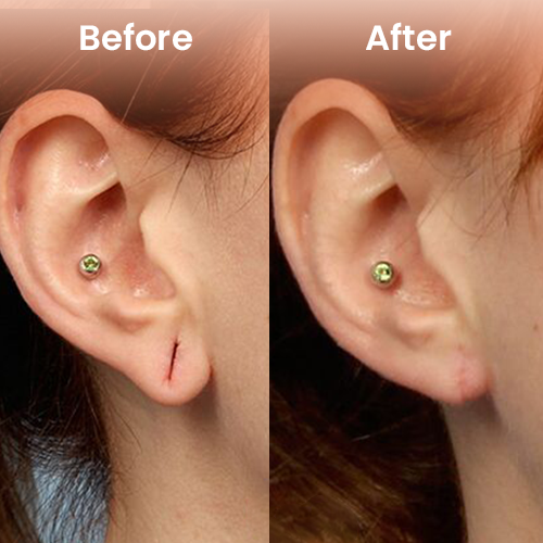 Female earlobe before and after