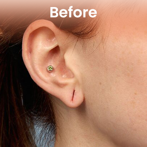 Female earlobe repair before