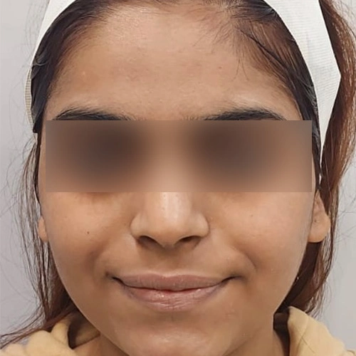 HydraFacial after Delhi