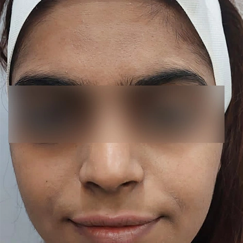 HydraFacial before Delhi