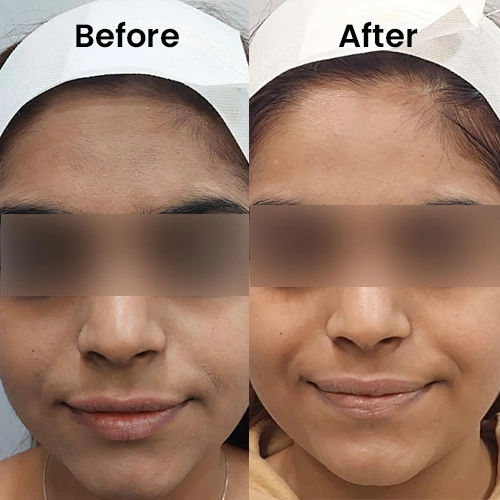 HydraFacial results Delhi