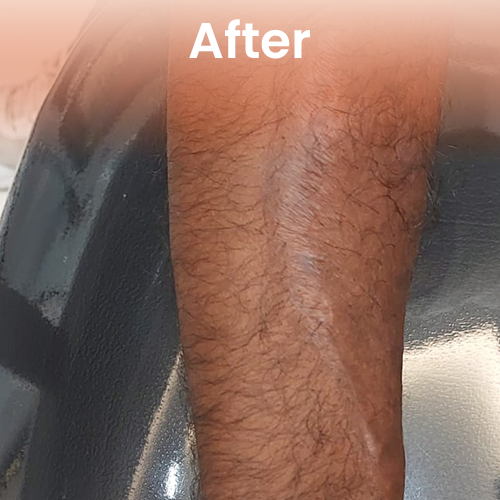 laser tatoo removel after