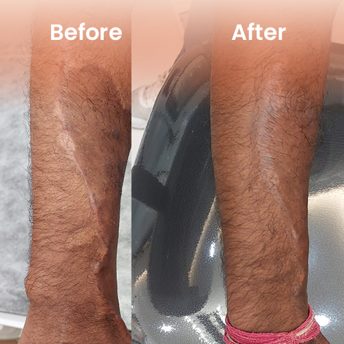 laser tatoo removel before after