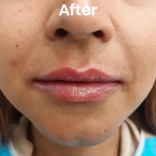 After volume enhancement