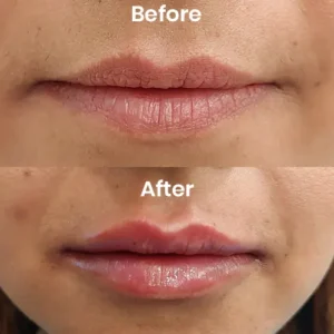 Volume enhancement lip transformation