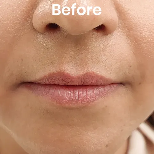 Before volume enhancement