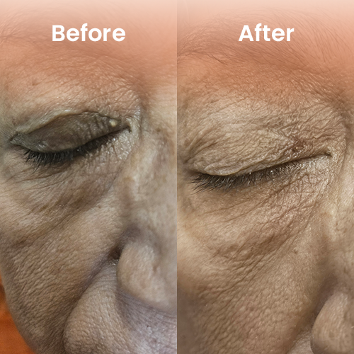 Mole removal results Delhi