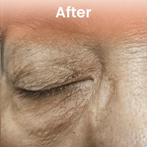 Post mole removal skin