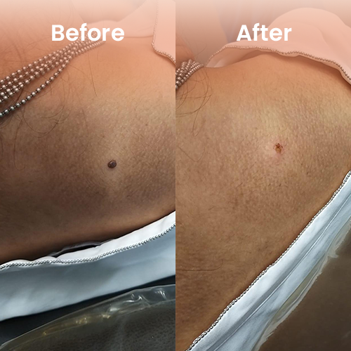 Mole removal before and after