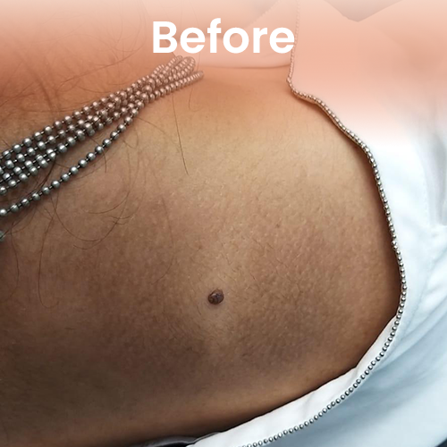 Facial mole before treatment