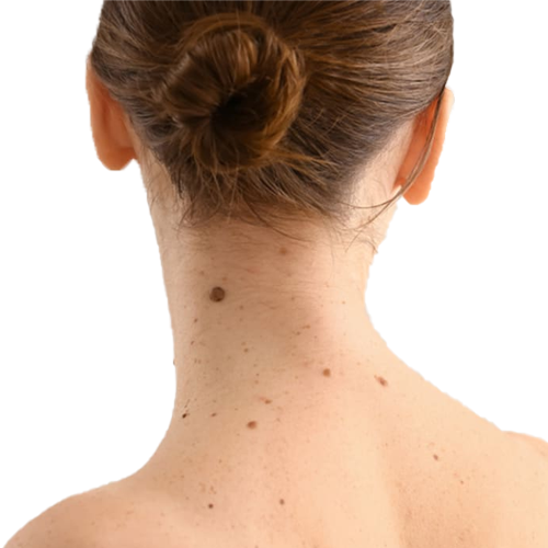 Mole Removal Treatment