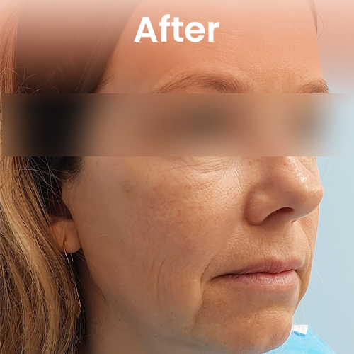 After non-surgical face lift