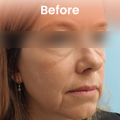 Before non-surgical face lift