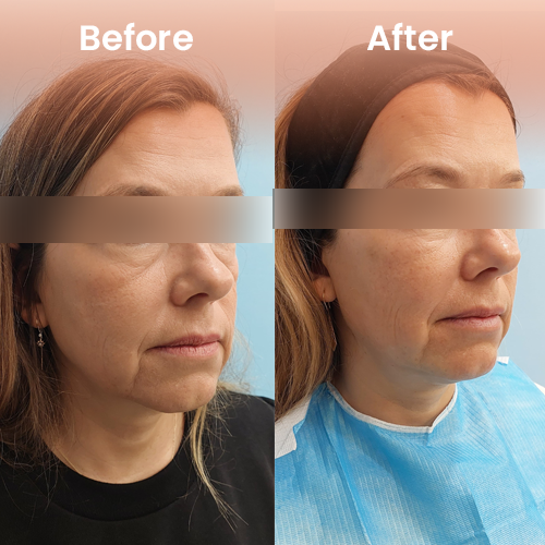 Non-surgical face lift results