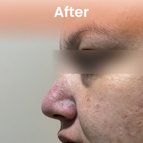 After nose pin hole repair treatment