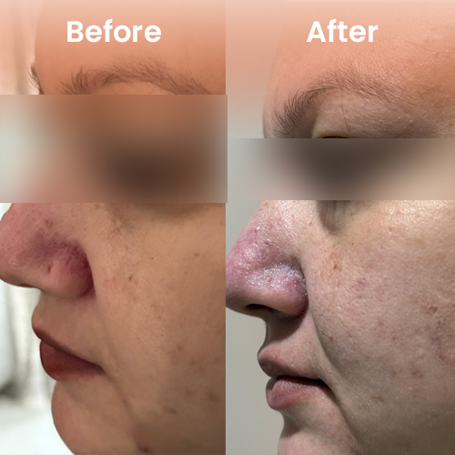 Before and after nose pin hole repair treatment