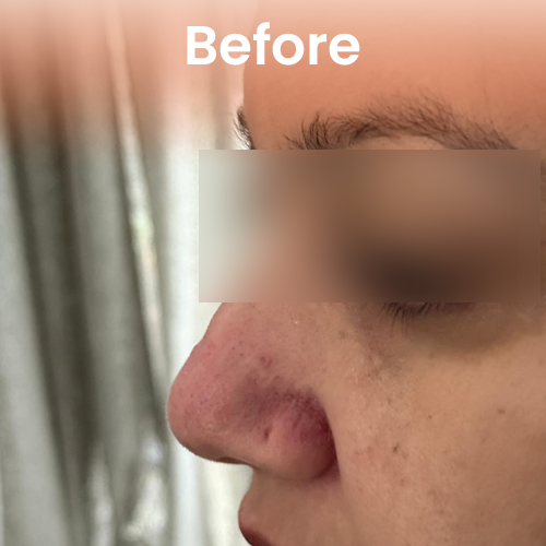 Before nose pin hole repair treatment