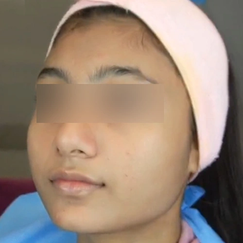 Oxygeneo facial after Delhi