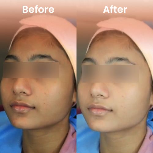Oxygeneo before and after