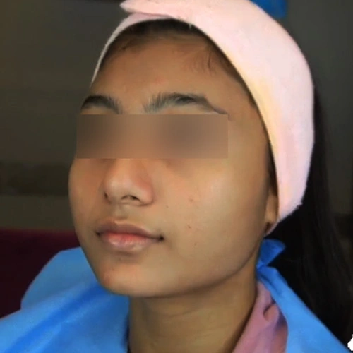Oxygeneo facial before Delhi