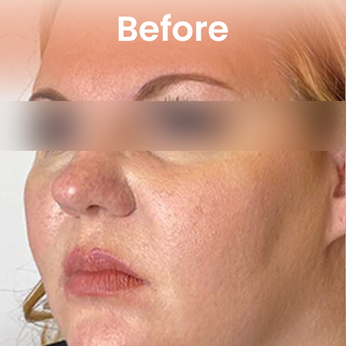 before Ozempic treatment