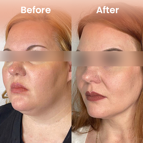 Ozempic weight loss treatment before and after – visible body transformation