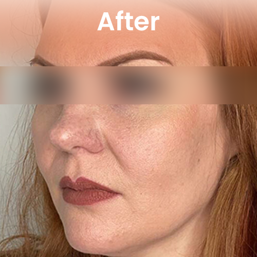 After Ozempic treatment