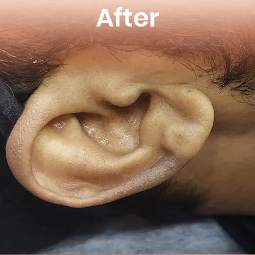 After laser hair removal – smooth, hair-free skin with long-term results