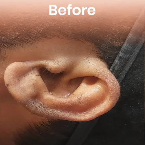 Skin before permanent hair reduction – visible hair growth for treatment