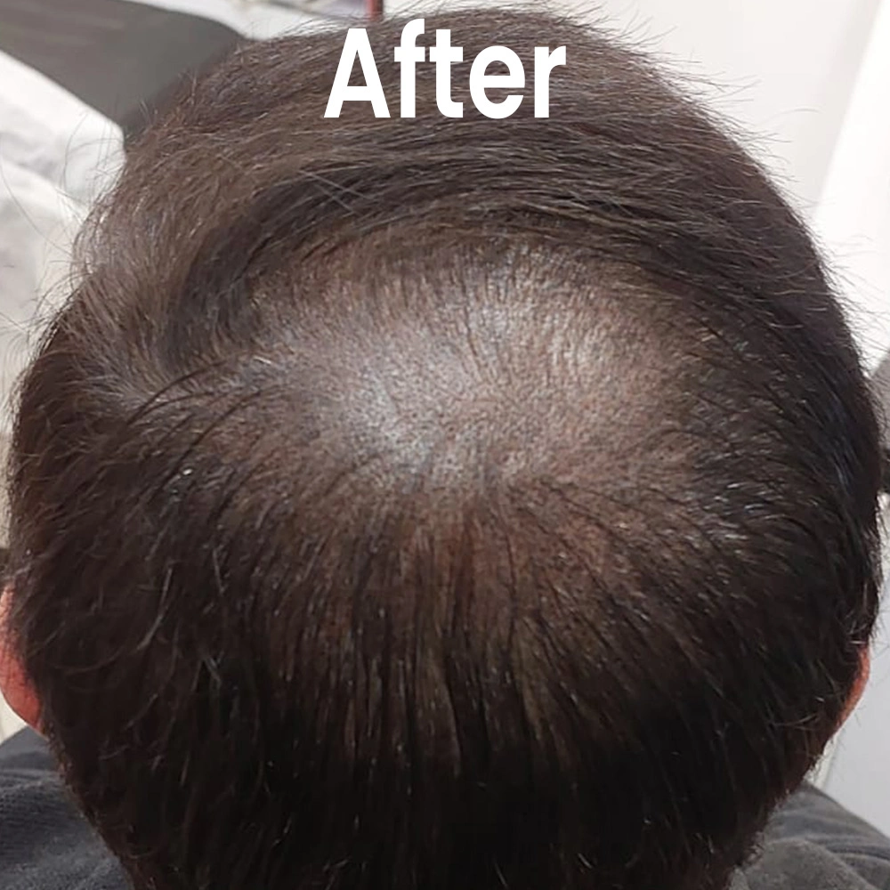 Scalp micropigmentation after Delhi