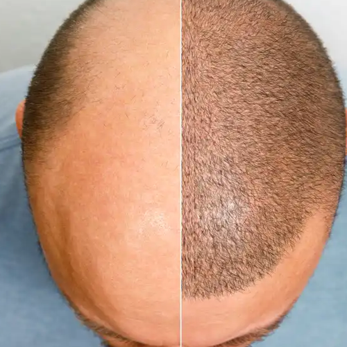 Scalp Micropigmentation Treatment