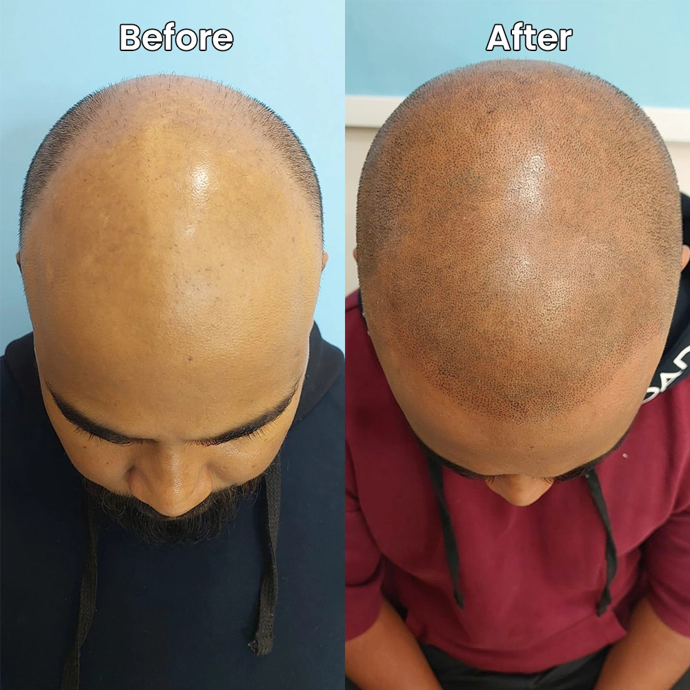 Scalp micropigmentation transformation Delhi