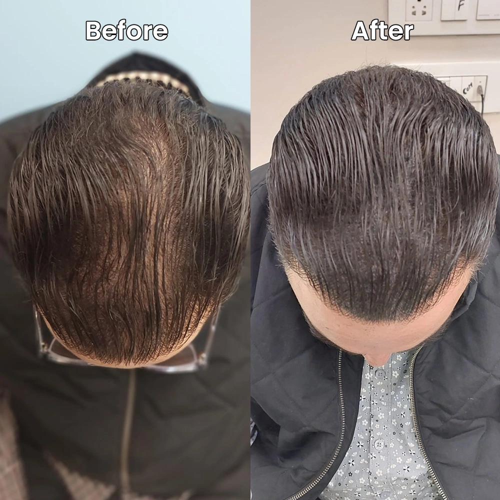 Hairline before after SMP Delhi