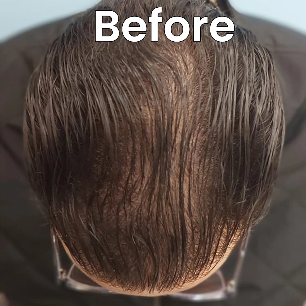 SMP scalp image before Delhi